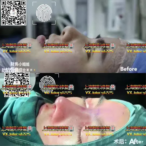 Facemaker修复整形