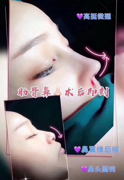 上海肋骨鼻整形