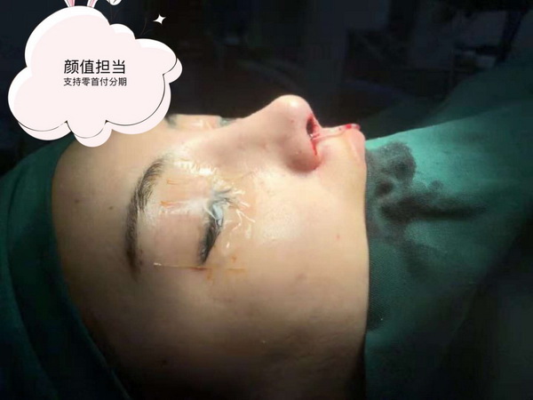 上海鼻整形修复