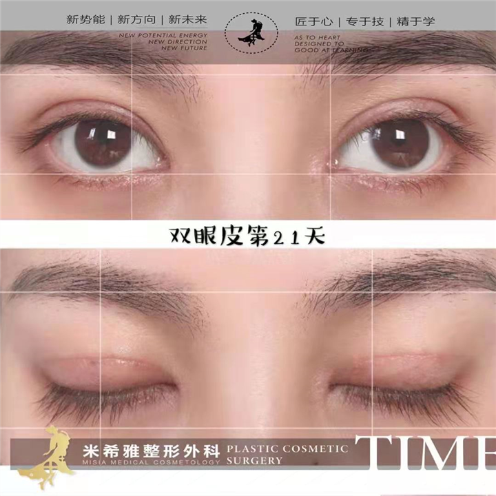 米希雅整形 
