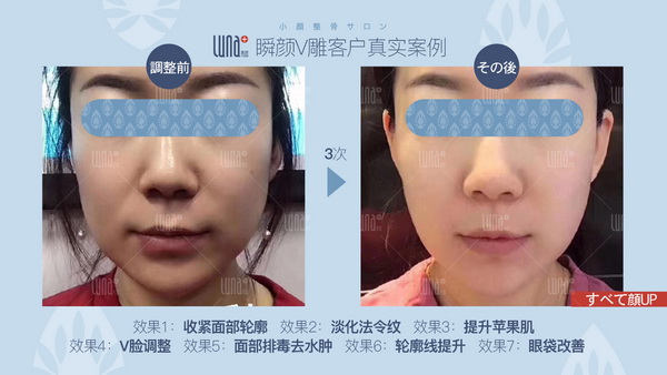 日式小颜整骨