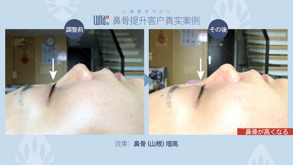 日式小颜整骨 