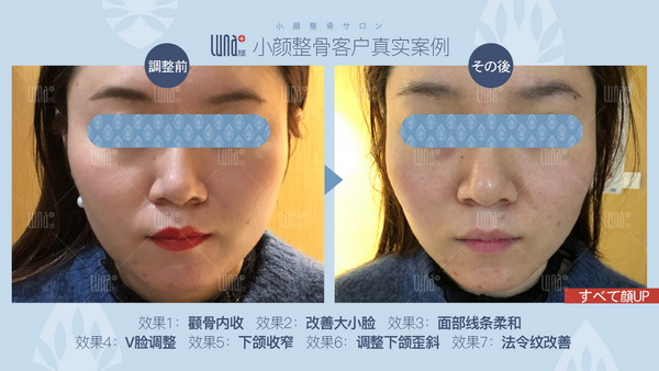 日式小颜整骨
