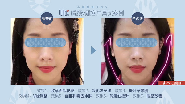 日式小颜整骨