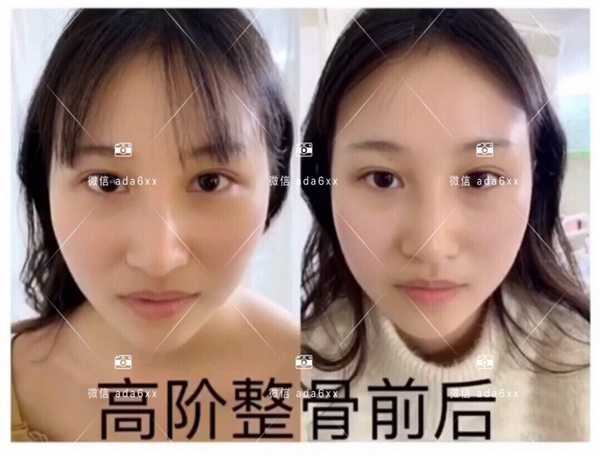 广州活细胞丰胸|广州埋线提升