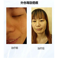 脸上疤痕可以去除吗