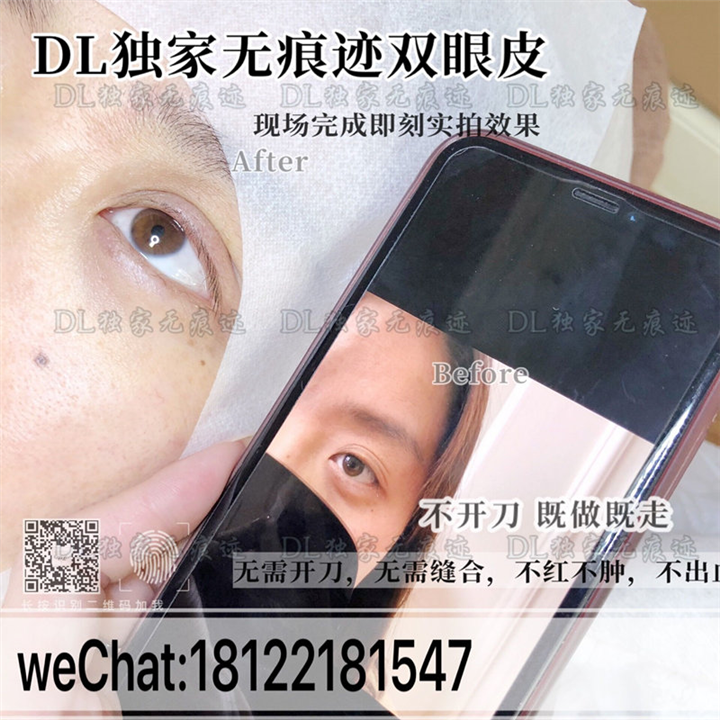 DL日式无痕双眼皮 