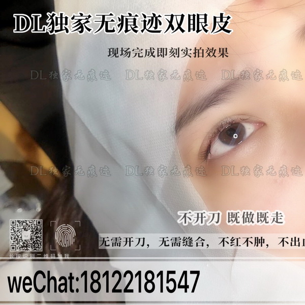 广州日式无痕双眼皮哪家好