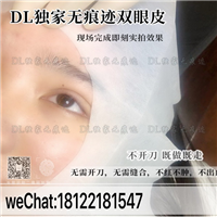 日式无痕双眼皮