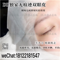 日式无痕双眼皮