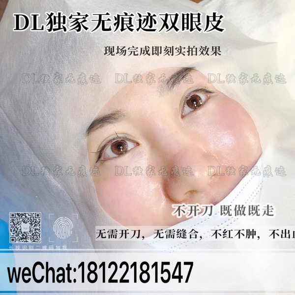 广州日式无痕双眼皮