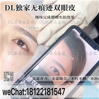 广州日式无痕双眼皮
