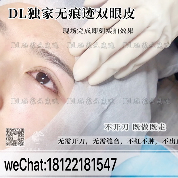 广州日式无痕双眼皮