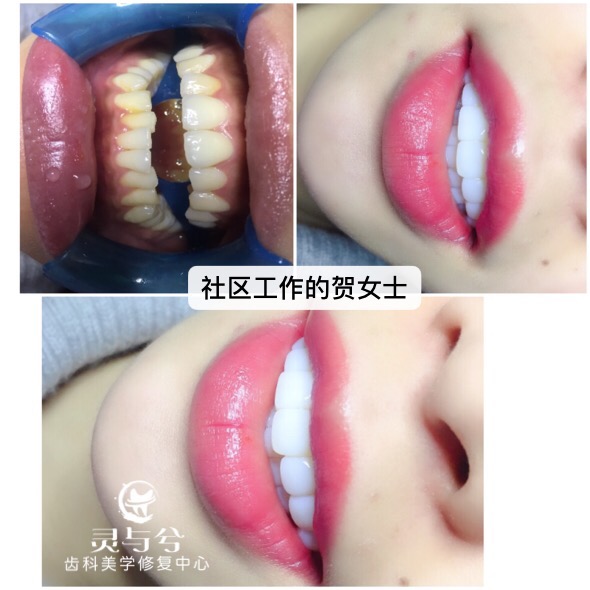 四川牙齿美白培训