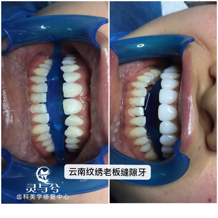 重庆牙齿美白