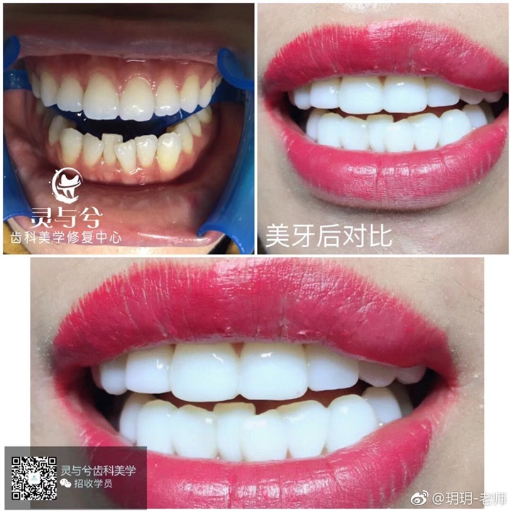 重庆德国冰瓷美牙培训