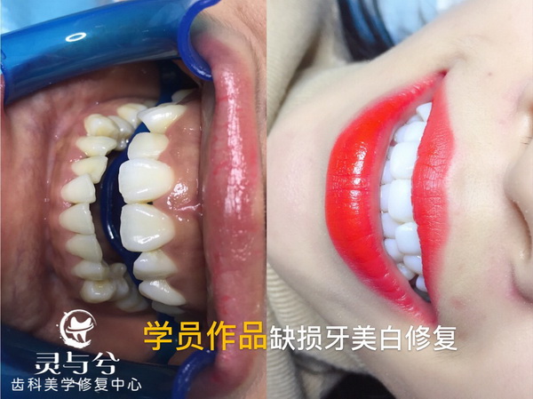 重庆瓷贴面美牙