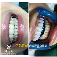 重庆瓷贴面美牙