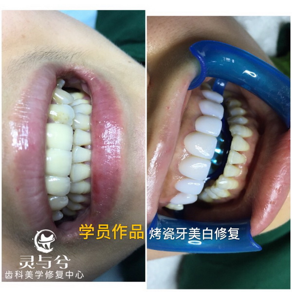 重庆瓷贴面美牙