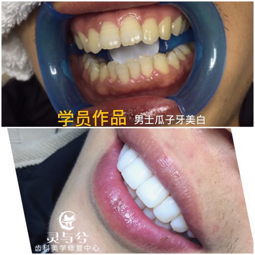 重庆贴面美牙培训