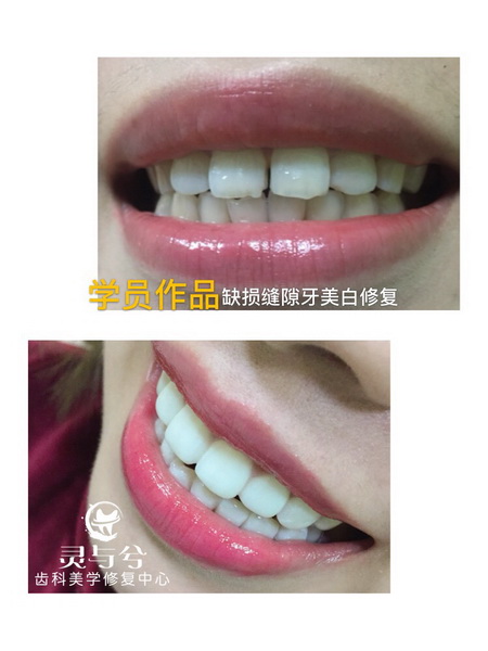 重庆贴面美牙培训