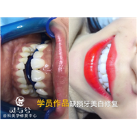 重庆瓷贴面美牙