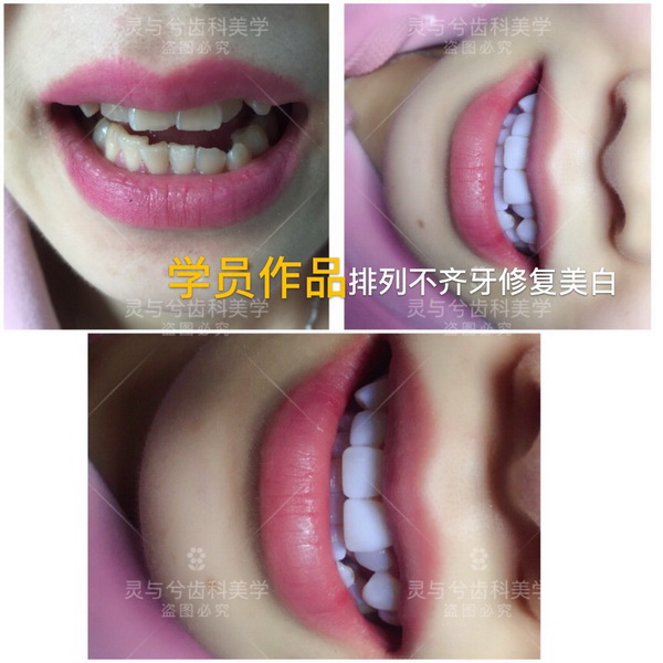 重庆瓷贴面美牙