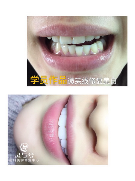 重庆瓷贴面美牙
