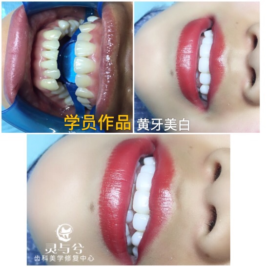 重庆贴面美牙培训