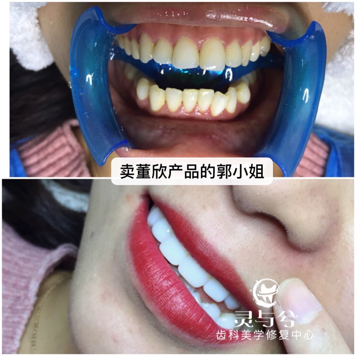 瓷贴面美牙培训,重庆瓷贴面美牙