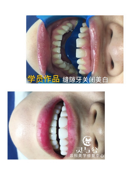 重庆贴面美牙培训
