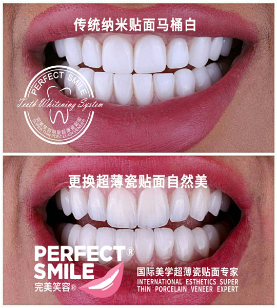 传统纳米贴面与瓷贴面对比 