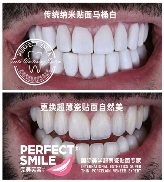 重庆牙齿瓷贴面 