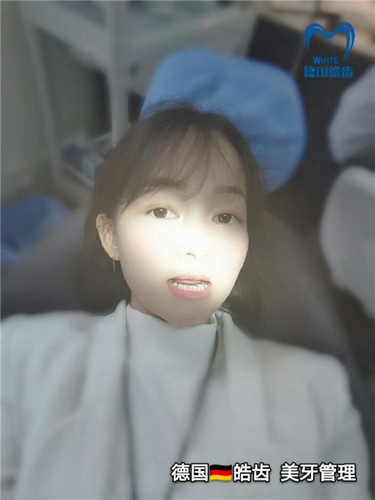 美牙源头厂家 