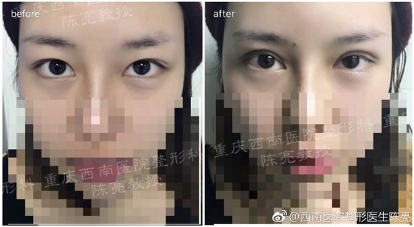 重庆西南医院陈亮整形