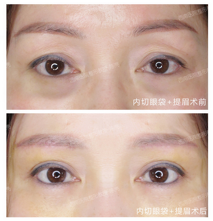 重庆眼部整形专家 
