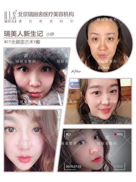 小伊（隆鼻）