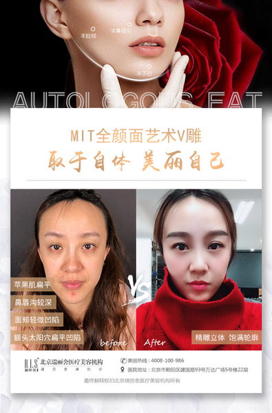 自体脂肪填充面部 