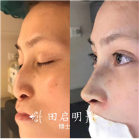 长沙鼻整形医生