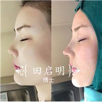 长沙鼻整形医生