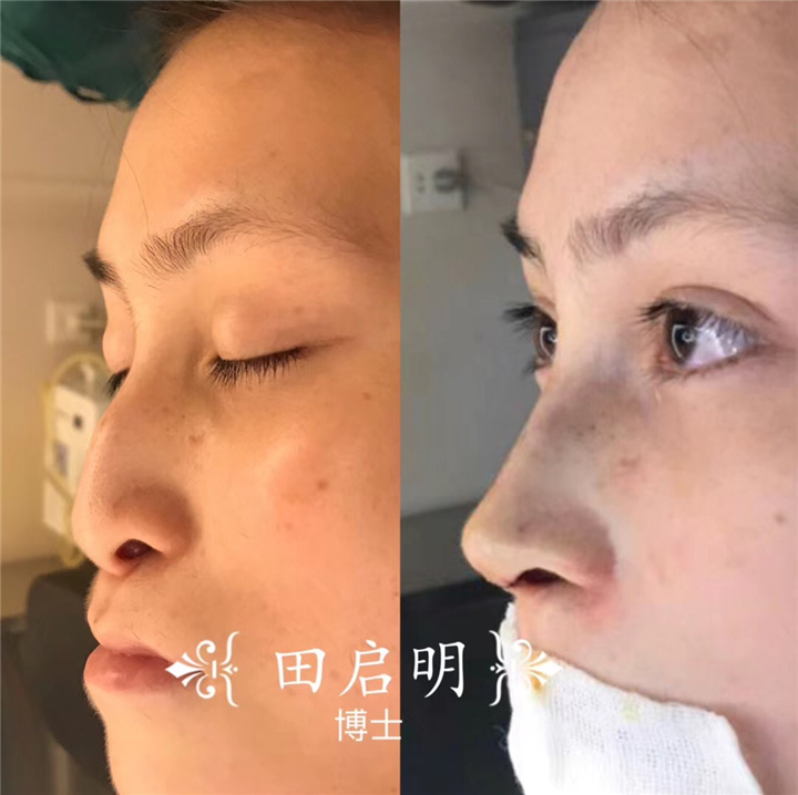 长沙鼻整形医生