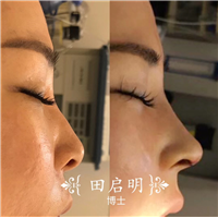 长沙鼻整形医生