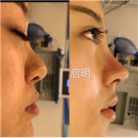 长沙鼻综合整形医生