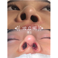 长沙肋骨鼻整形专家