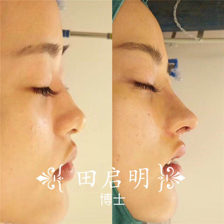 长沙鼻综合整形医生