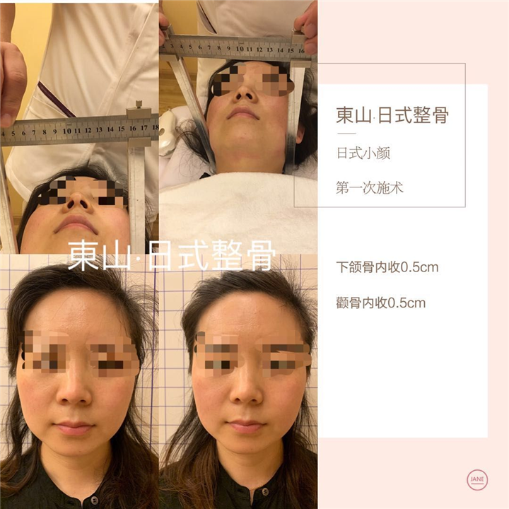 江苏淮安東山家日式整骨做一次多少钱? 