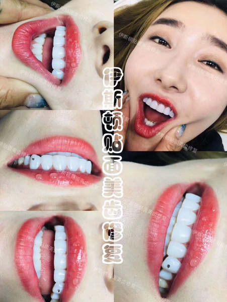 冰瓷美牙培训