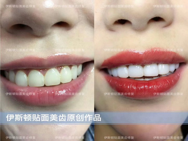 成都牙齿美白培训