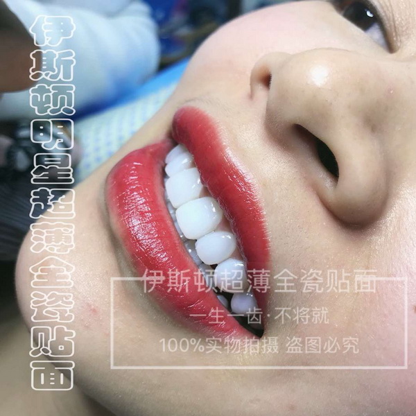冰瓷美牙培训
