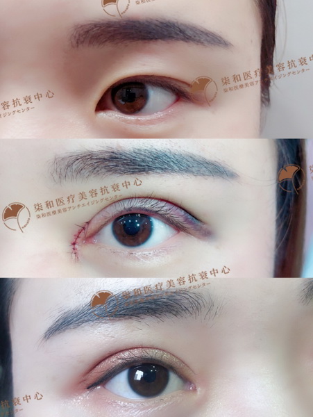 长沙网红整形